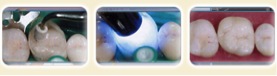 Ajustements CEREC